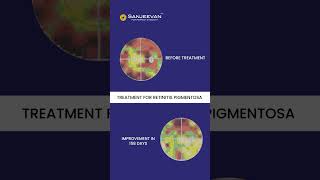 Retinitis Pigmentosa Treatment  Improvements in 158 Days [upl. by Eneloc415]