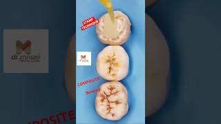 STAMP Technique for Composite direct fillings [upl. by Lubbi]