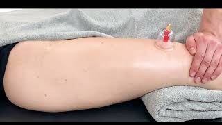 Myofascial Cupping  Quadriceps and TfL [upl. by Ymiaj]