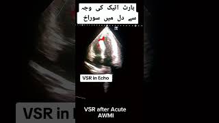 VSR  دل کے اٹیک کے بعد دلمیں سوراخ anatomy heartbloodflow health echocardiography [upl. by Alhak800]