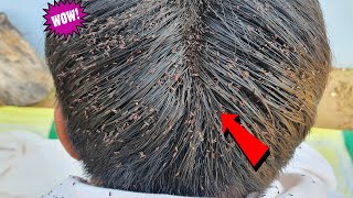 Thousand lice on heads boy removal  Lice comb [upl. by Fadil]