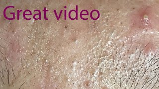 Acne Treatment Huong Da Nang membership 016 Treatment for Dung  great video [upl. by Dev]