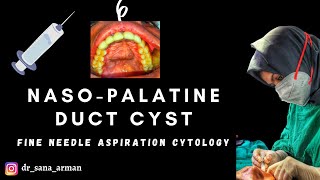 Nasopalatine Duct Cyst [upl. by Anjanette]