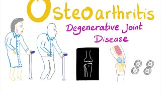 Osteoarthritis OA  Definition Causes Etiology amp Epidemiology  Part 2  Rheumatology [upl. by Aerdnaeel]