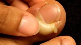 Paronychia What Are Nail Infections [upl. by Vitale]