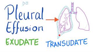 Pleural Effusion  Transudate or Exudate  Causes and Liddle’s Criteria Pulmonary Medicine Playlist [upl. by Yoo]