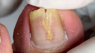 Severe Toenail Fungal Infection Treatment  Digging Out Dead Toenails【Foot scalpel】 [upl. by Areval]