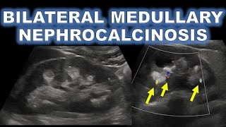 MEDULLARY NEPHROCALCINOSIS ON ULTRASOUND [upl. by Derzon]