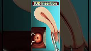 IUD insertion neet biology neetmotivation IUD motivation [upl. by Martens]