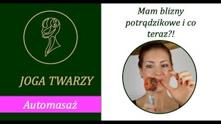 Joga Twarzy  Mam blizny potrądzikowe  i co teraz [upl. by Ellimac]