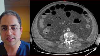 Qual o passo a passo para dar diagnóstico de isquemia mesentérica na TC de Abdome [upl. by Brom]