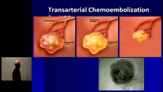 Hepatocellular Carcinoma Optimal Treatment and Transplantation [upl. by Jeannie966]