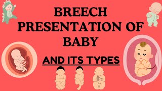 Breech Presentation of Baby Understanding Types Risks and Delivery Options Novice Medic [upl. by Ymaj]