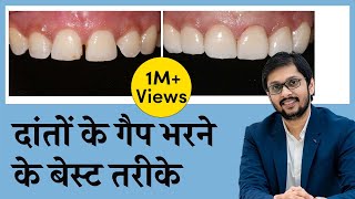 दाँतो के बीच की गैप को कैसे ठीक करें  CloseFill Gap In Teeth  Seraphic Dental Indore  Dr Ankit [upl. by Josias]