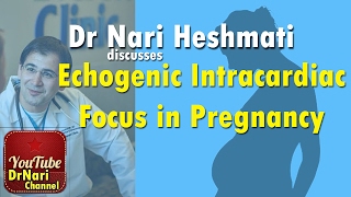 EIF or echogenic intracardiac focus in fetal left ventricle ultrasound and fetal echo video [upl. by Doy]