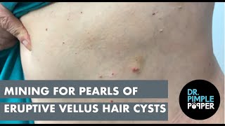 Mining for Pearls of Eruptive Vellus Hair Cysts [upl. by Chainey98]