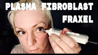 PLASMA FIBROBLAST FRAXEL  At home skin tightening [upl. by Aiyotal]