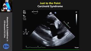 Carcinoid Syndrome [upl. by Ruscio]