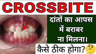 Crossbite Dental Condition 🦷  Cause Problem and Treatment [upl. by Willi]