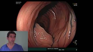 Ulcerative colitis SCENIC Protocol Dr GallardoDra Miras [upl. by Nyleikcaj]