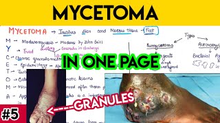 Mycetoma explained in simplified way with mnemonic 🤯  mycology microbiology MCWA [upl. by Anilam]