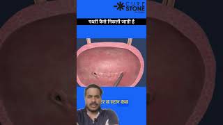 Kidney Stone Treatment  RIRS Ureteroscopy  shorts youtubeshorts studentdoctorsshortsfeed [upl. by Scales506]