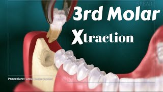 Tricks for Lower 8 third molar wisdomtooth extraction removal with elevator amp forcep Technique [upl. by Ahkos]