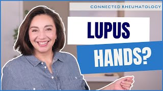 The 3 ways Lupus can affect your hands  a Rheumatologist explains [upl. by Maddox398]