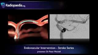 Stroke Endovascular management of ischaemic stroke  radiology video tutorial [upl. by Siroled259]