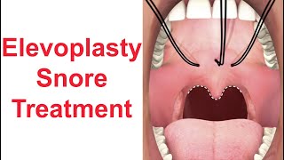 Elevoplasty Snore Treatment [upl. by Aneras163]