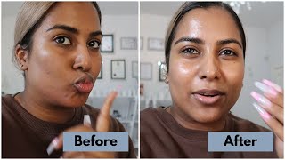 Skin Vlogs with Dr Saffia Jacobs  Melanostop Peel [upl. by Osicnarf611]