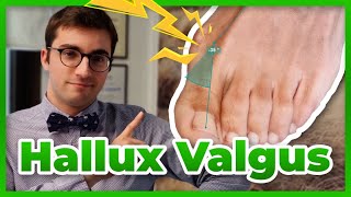 Hallux valgus  diagnostic prévention et traitement [upl. by Namolos]