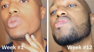 Minoxidil Beard Journey 3 Month Transformation [upl. by Ahsiekat]