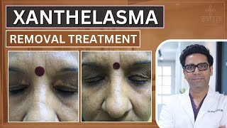 Xanthelasma Removal Treatment  Xanthelasma Removal  Xanthelasma Removal Laser  Xanthelasma [upl. by Iramo]