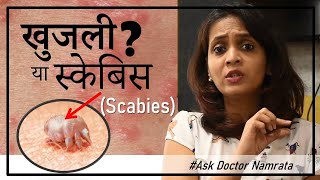 ये खुजली क्या स्केबिस  Scabies  है  क्यों हुआ  इलाज कैसे करे  AskDoctorNamrata [upl. by Saba]