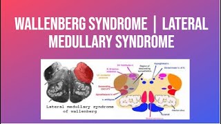 Wallenberg Syndrome  Lateral Medullary Syndrome  PhysiotherapyKnowledge [upl. by Akirdnas138]