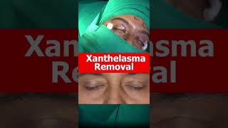 XANTHELASMA Removal Treatment At Shobhit Aesthetics [upl. by Nolak488]