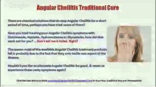 Angular Cheilitis Cream  Angular Cheilitis Treatment [upl. by Aneeres782]