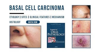 Basal cell carcinoma  Epithelial Pathology  Histology  Etiology  Oral Pathology [upl. by Jamel175]