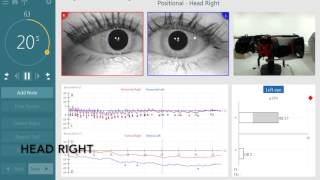 BPPV Assesment with the new TRV Chair by Interacoustics [upl. by Aihsas]