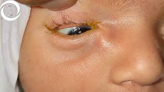 Congenital Lacrimal Encysted Mucocele [upl. by Filide]