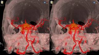 Cavernous Meningioma  3D Virtual Tour  UCLA Neurosurgery [upl. by Enidan951]