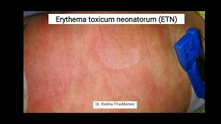 Erythema Toxicum Neonatorum  Pediatrics [upl. by Naiviv352]