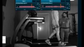 Quadriceps Avoidance Walking Gait Analysis [upl. by Enetsuj]