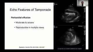 Echocardiography for Pericardial Effusions and Tamponade [upl. by Sancho785]