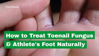 How to Treat Toenail Fungus amp Athletes Foot Naturally [upl. by Aifas]