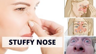 How to Cure Stuffy Nose  6 Home remedies for stuffy nose [upl. by Noma945]