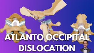 Atlanto Occipital Dislocation Causes Assessment and Treatment [upl. by Cooley535]