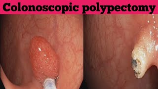 Haemorrhoids amp Sigmoid colonic polyp l l Endo Cut [upl. by Neyr140]