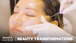 How Nonsurgical FaceLifts Work With PDO Threads  Beauty Transformations  Insider Beauty [upl. by Juno]